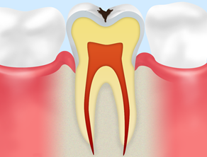C1(エナメル質の虫歯)