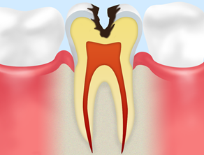 C2(象牙質の虫歯)