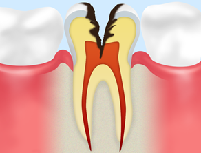 C3(神経まで達した虫歯)