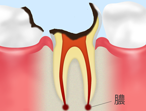 C4(歯根まで達した虫歯)