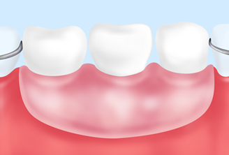 入れ歯（保険適用の場合）
